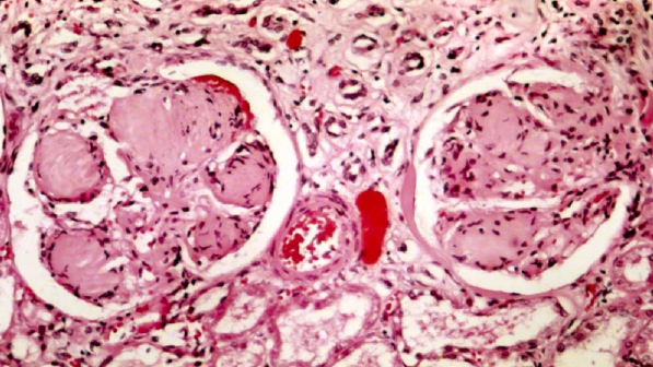 Diabete Trapiantate cellule del Pancreas